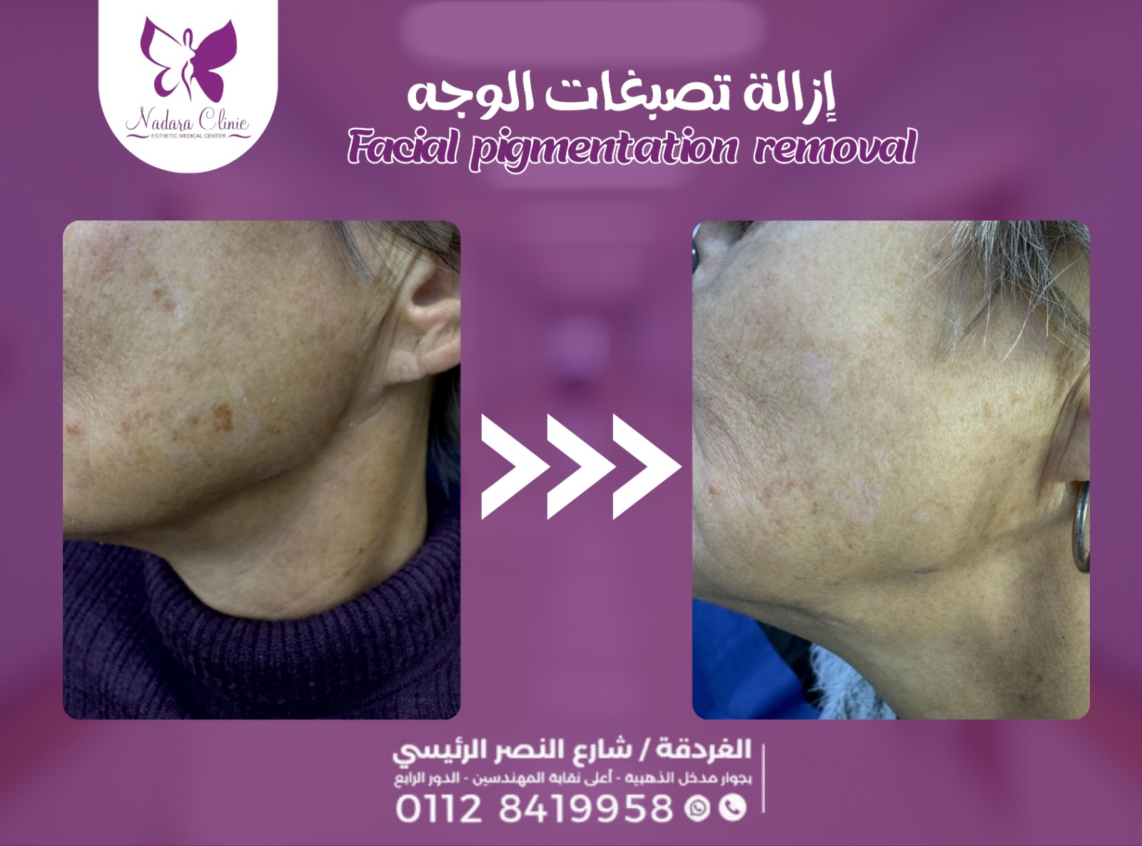 ازالة تصبغات الوجه في الغردقة